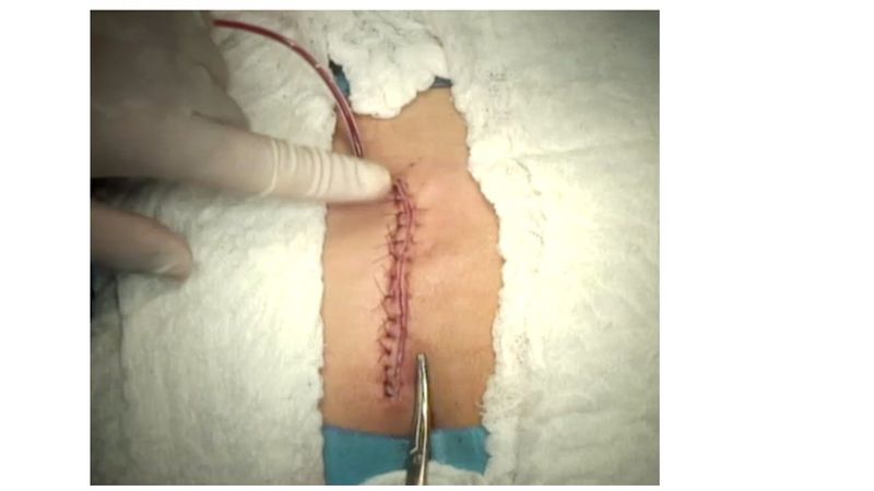 Karydakis Technique for the Treatment of Pilonidal Disease