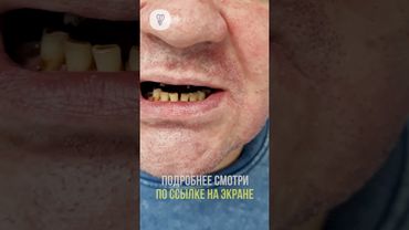 Всё плохое позади, впереди новая жизнь с новыми зубами. Имплантация зубов.