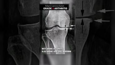 Knee Arthritis: Mild to Severe to NEW #shorts