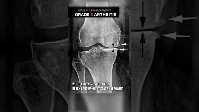 Knee Arthritis: Mild to Severe to NEW #shorts