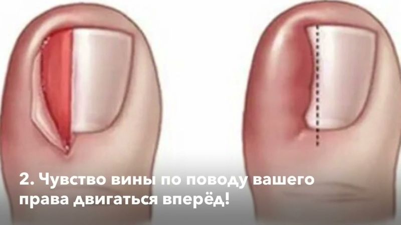 Вросший ноготь пальца стопы. Исцели себя сам, изменив своё сознание!