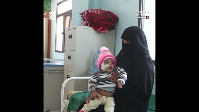 تقرير دولي: نحو 90 ألف طفل في اليمن يعانون سوء تغذية حادا