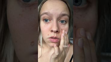 удалила НА ЛИЦЕ лазером...