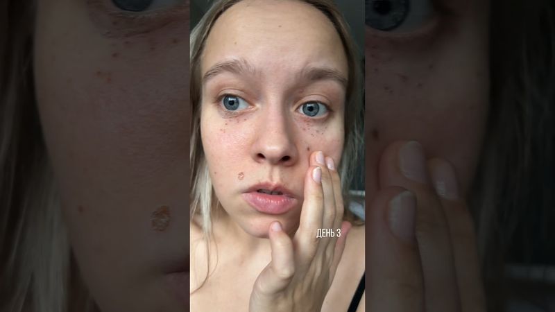 удалила НА ЛИЦЕ лазером...