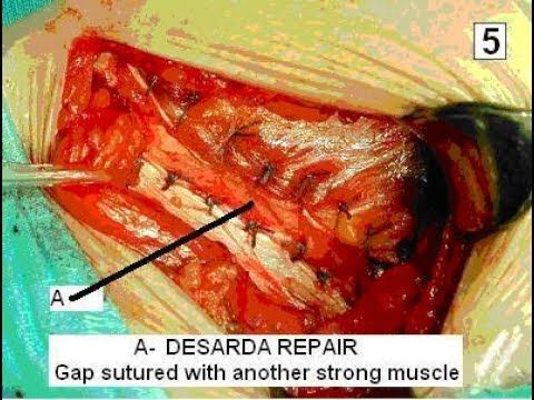 Steps of Operation in Desarda Repair, No Mesh Inguinal Hernia Surgery, Mesh Free Hernia Surgery