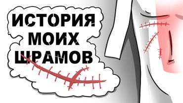 ПОКАЗЫВАЮ ШРАМЫ и ИХ ИСТОРИИ