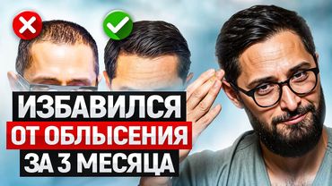 Мужское облысение - не приговор! Моя история избавления от залысин без пересадок