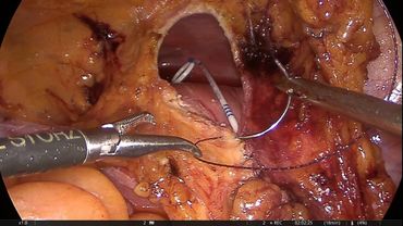 Laparoscopic Boari Лапароскопическая операция Боари