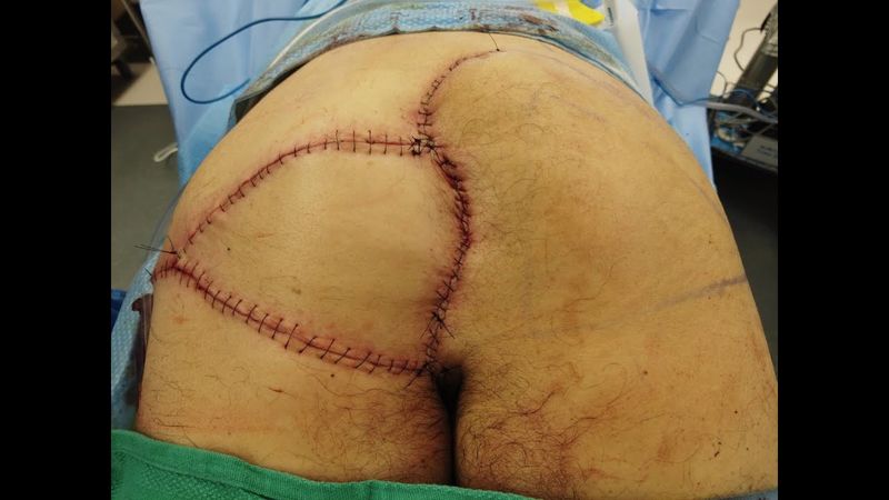 رفرف تقدم اللفافة الجلدية الألوية V-Y