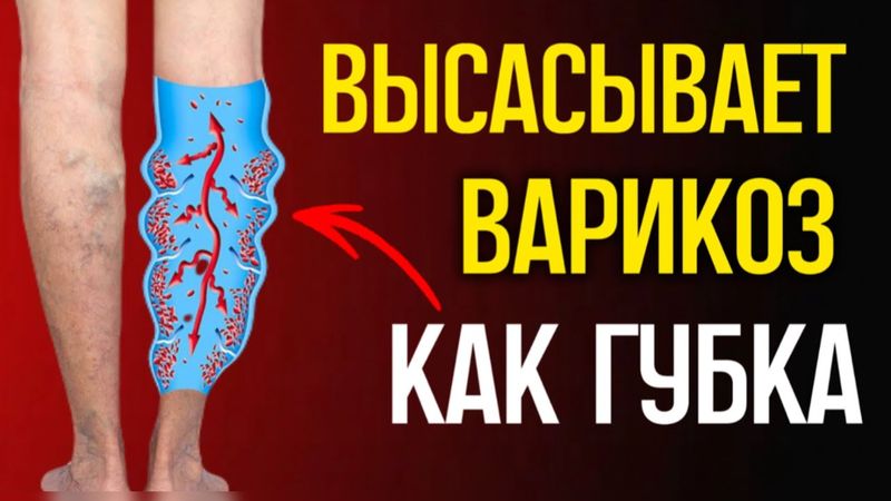 Оказывается, варикоз реально лечится! Простые средства есть у каждого дома!