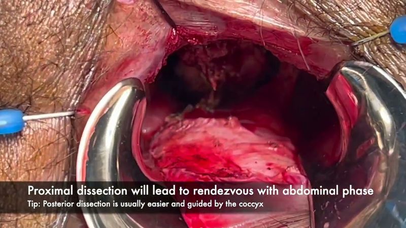 Hand-sewn Coloanal Anastomosis