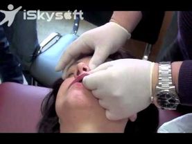 Эстетика лица, мануальная коррекция носогубной складки