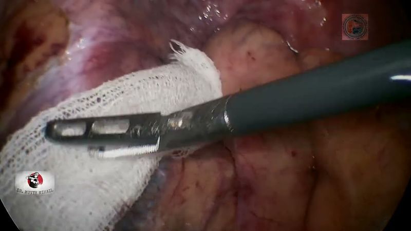 Lap. Anterior Resection,Rectal Cancer,D3/Лап. передняя резекция, Д3