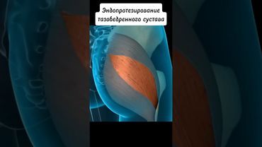 Эндопротезирование тазобедренного сустава