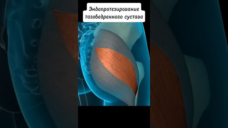 Эндопротезирование тазобедренного сустава