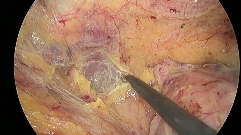 Laparoscopic Abdominoperineal Excision w/ En-Bloc Prostatectomy for Locally Advanced Rectal Cancer