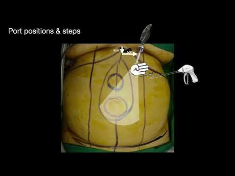 eTEP RS limited bottoms up TAR