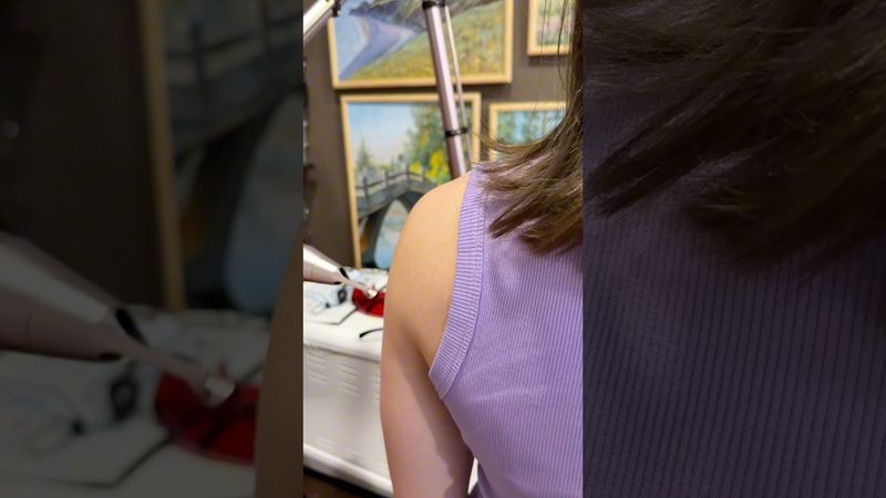 ЛАЗЕР частично удалил ТАТУ