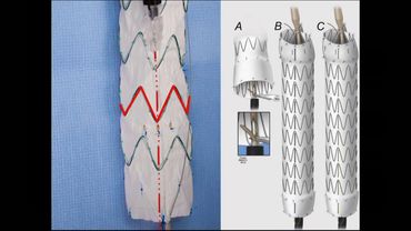 Dr. Gustavo Oderich - Physician Modified Fenestrated Endografts: Technical Aspects and Outcomes