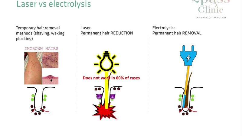 Laser hair removal vs Electrolysis