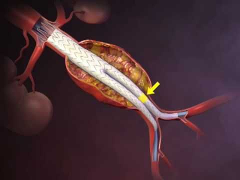 NEJM Procedure: Deployment of an Endovascular Graft in an Abdominal Aortic Aneurysm