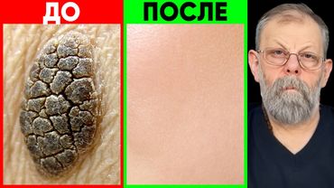 Cheratosi — ti spiego perché compaiono e come eliminarle