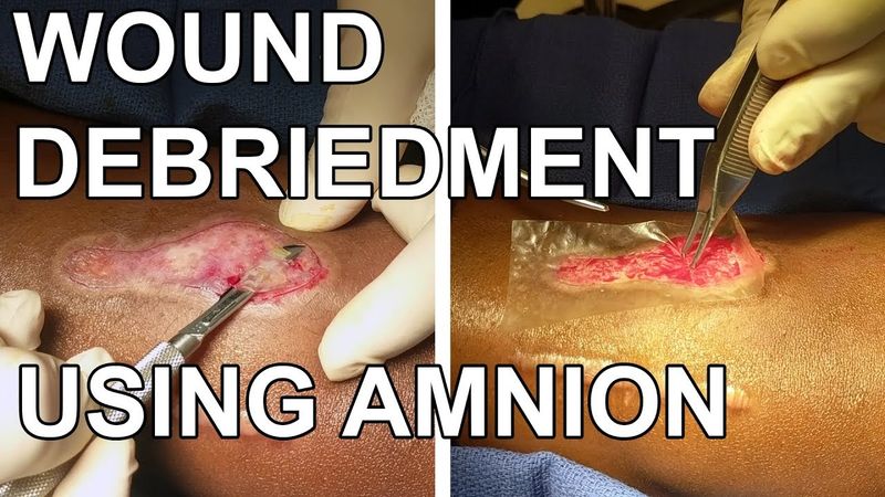 Wound Debridement with an Application of an Amnion - Dr. Paul Ruff | West End Plastic Surgery