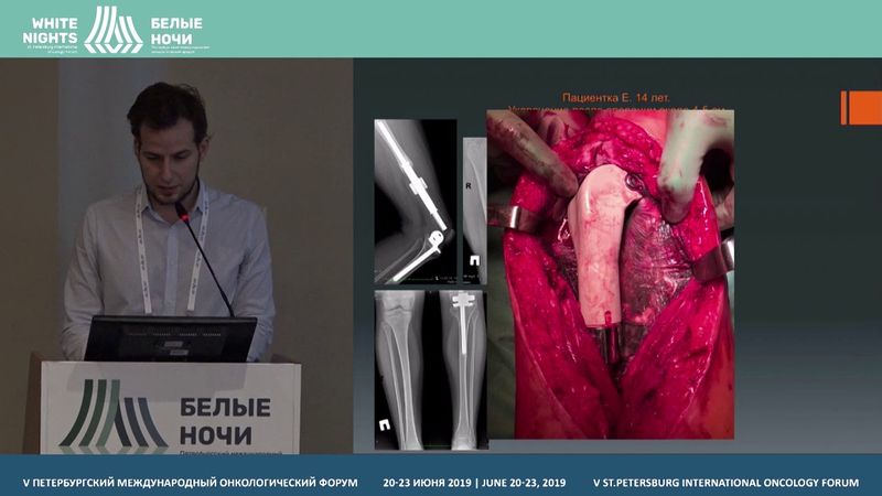 Осложнения хирургического лечения юных пациентов с опухолями костей  (Большаков Н.А.)