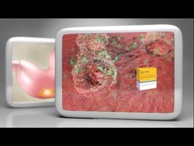 (2015) Де-Нол - Настоящая защита от язвы и гастрита