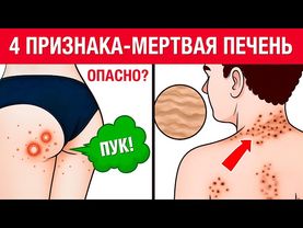 6 главных признаков УМИРАЮЩЕЙ ПЕЧЕНИ! Как быстро проверить здоровье печени?