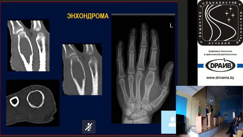 Дифференциальная диагностика злокачественных опухолей костей: доброкачественные образования