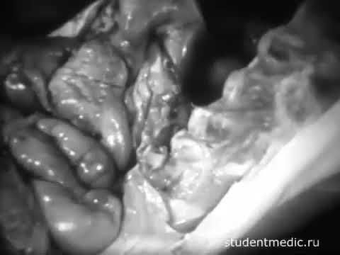 вскрытие трупа по Шору(16+) учебный фильм для медвузов 1978