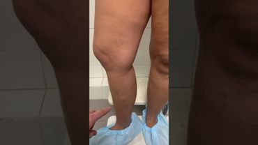 История одной операции ⚡️ лечение варикоза без наркоза, без боли и без госпитализации.