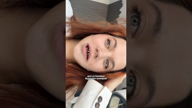 Мне сточили зубы?🫢 #стоматология #виниры #турция #анталья #блог #лайф #простовита