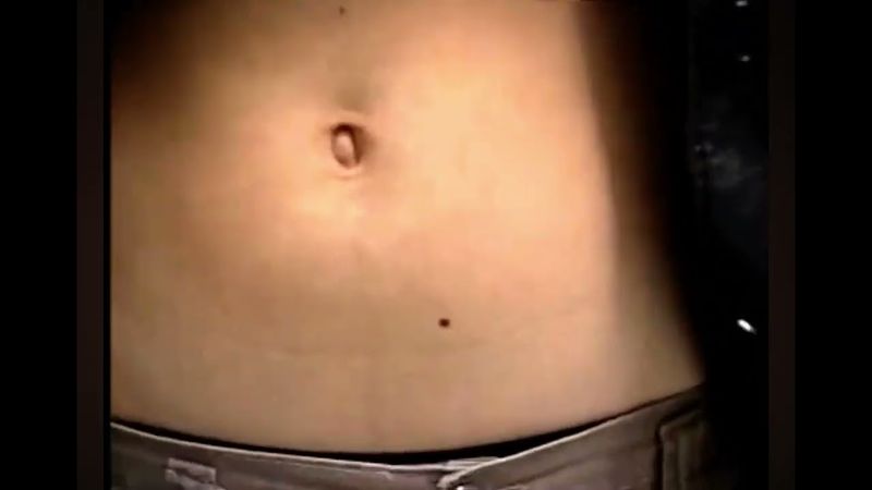 Outie bellybutton