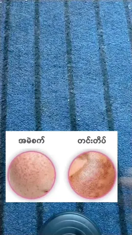 #Dark spots လေးတွေပျောက်ဖို့နည်းလမ်း##အမည်းစက်တင်းတိတ်တွေမဖြစ်အောင်ကာ...